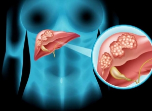 Ung thư gan: Nguyên nhân do đâu? Cách điều trị như nào?